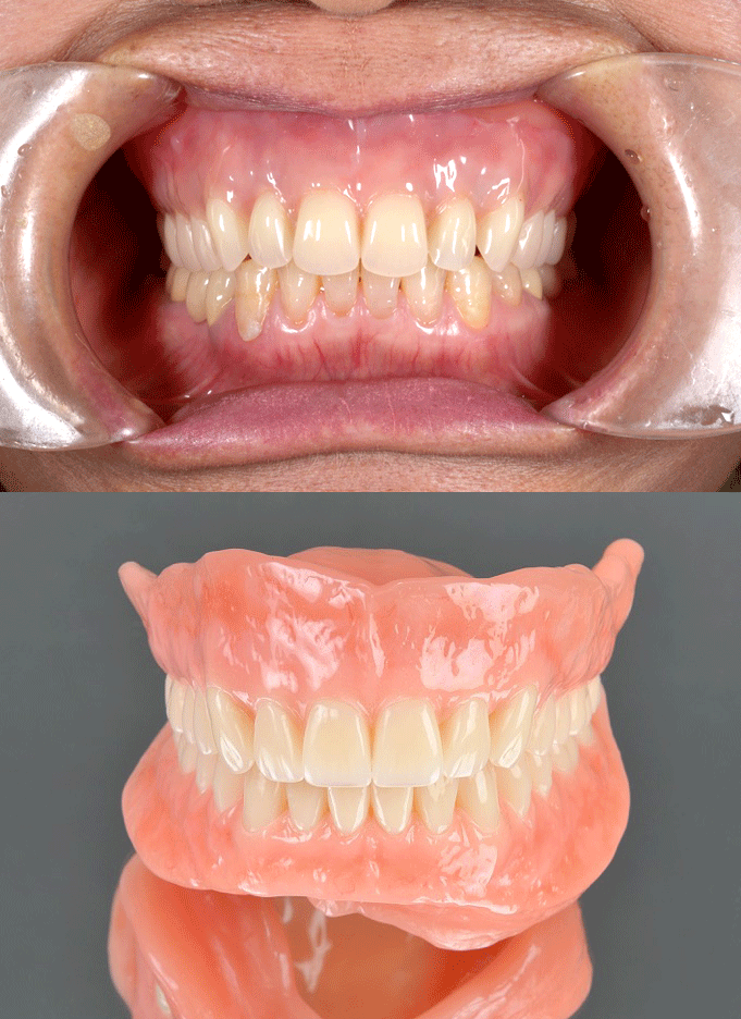 BPS義歯